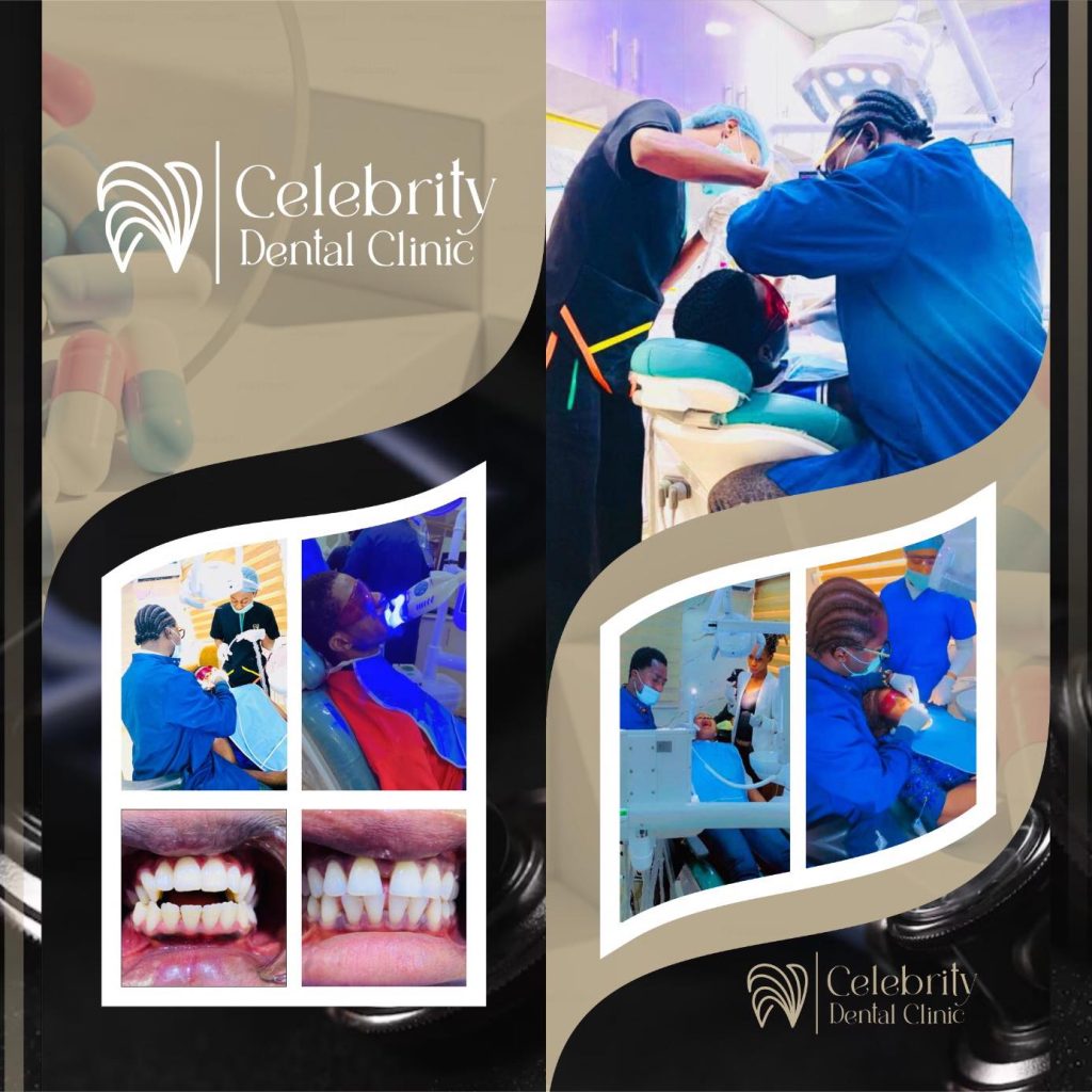 composite veneer